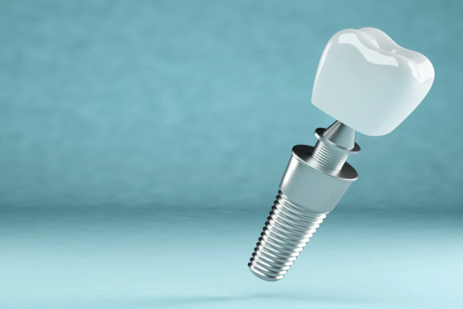 Impianti dentali vs. Protesi dentarie: Quale fa per te?