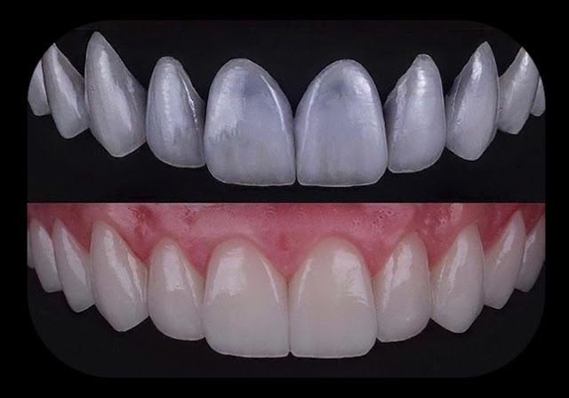 Faccette Dentali: Trasformare il Sorriso in Modo Rapido e Naturale