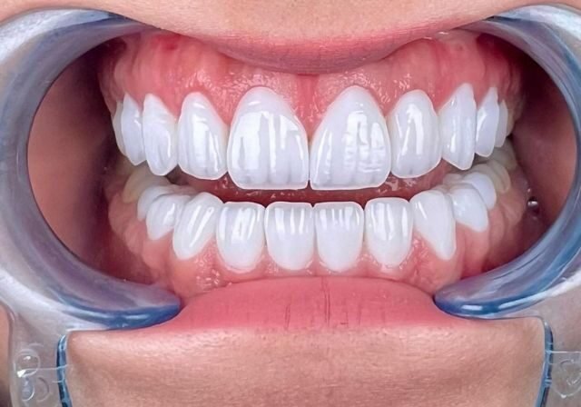 Corone Dentali in Zirconia o in Ceramica? Guida alla Scelta Migliore