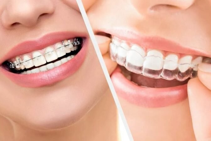 Invisalign: Quanto Tempo Serve per Vedere i Primi Risultati?