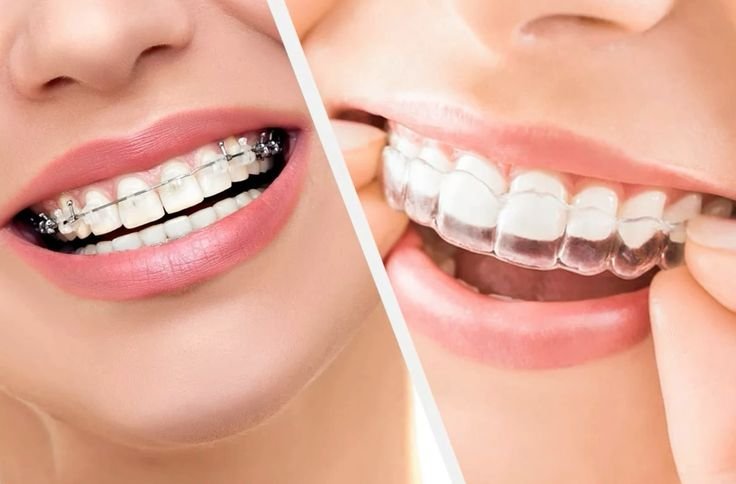 Invisalign: Quanto Tempo Serve per Vedere i Primi Risultati?
